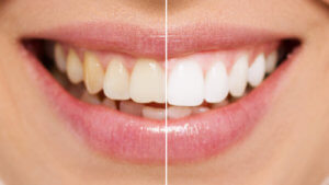Strahlend weiße Zähne durch moderne Bleaching Verfahren.