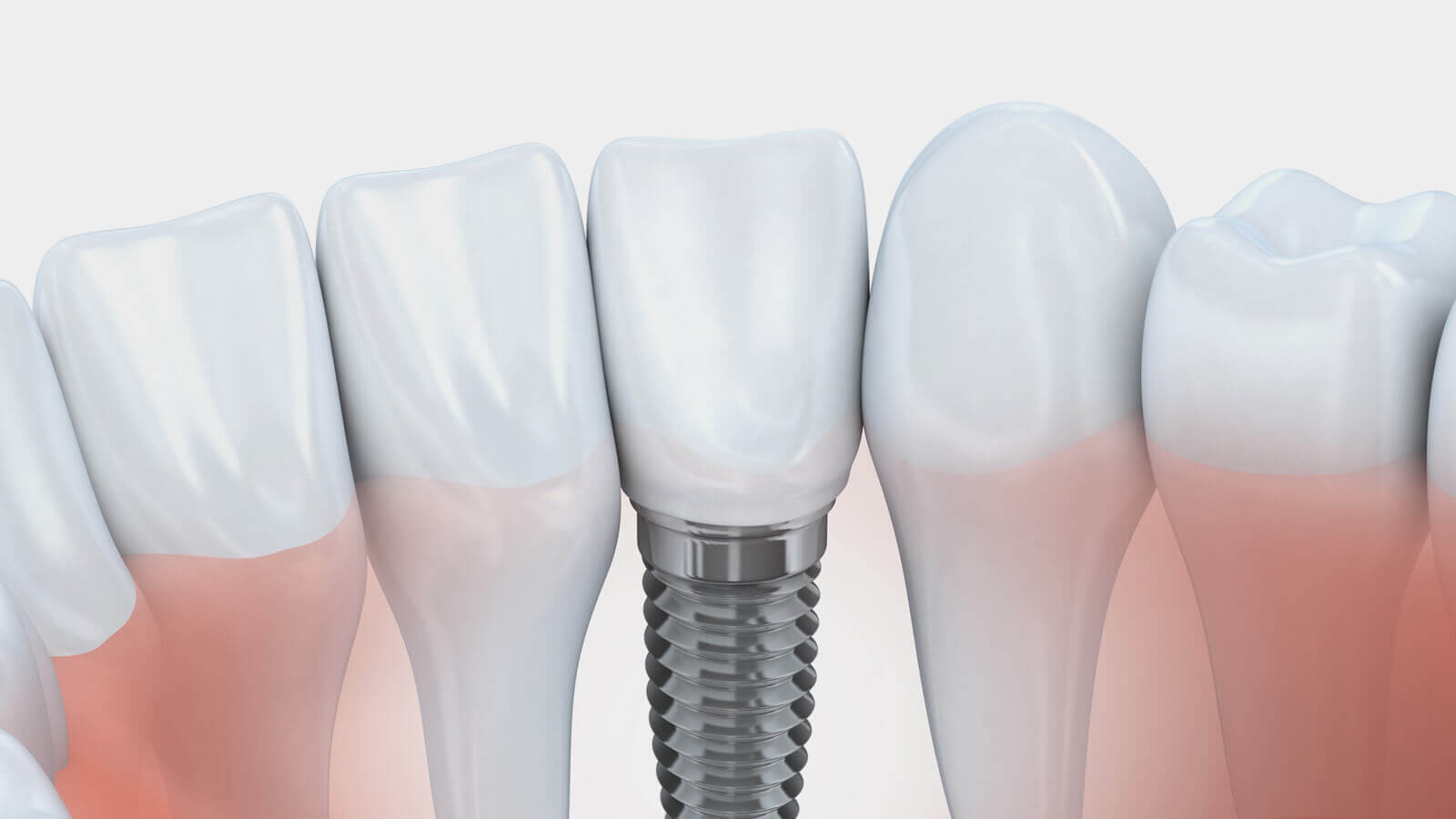 Implantate Köln: Dreidimensionale Planung der optimalen Position für das Zahnimplantat