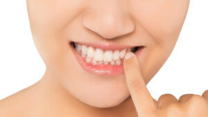Parodontitis ist eine bakterielle Entzündung des Zahnfleischs